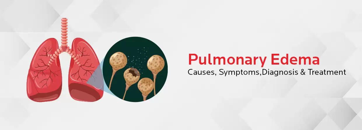 Your Ultimate Guide to Pulmonary Edema